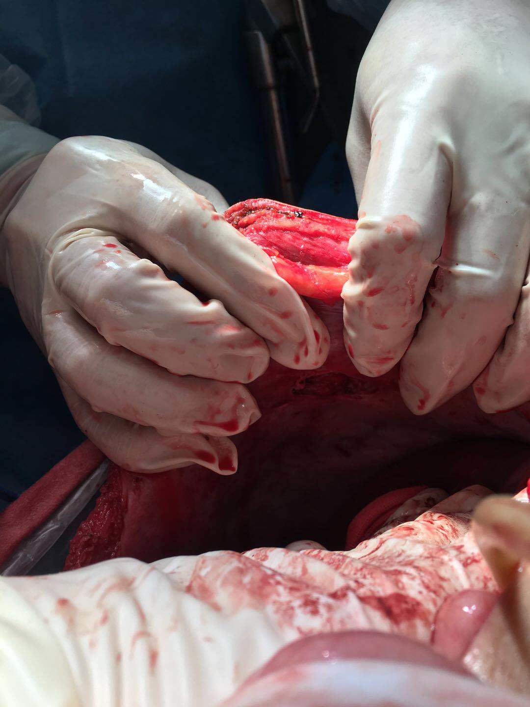 枪击伤:尽量而不强求彻底取除子弹,止住血,通畅引流 - 好大夫在线