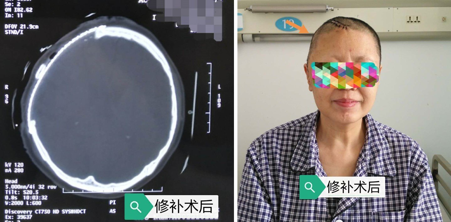 看圖說話:顱骨缺損修補術是怎麼回事 - 好大夫在線