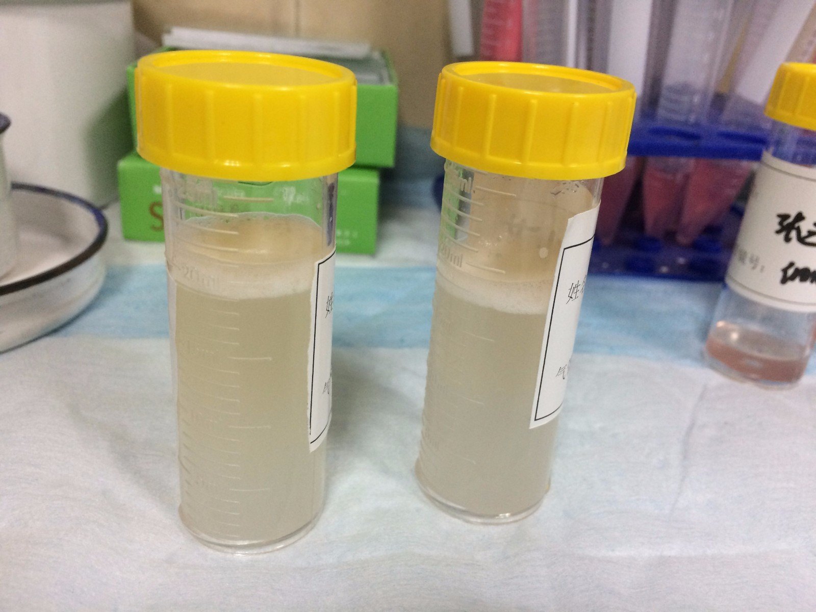 沈医生介绍肺泡蛋白沉积症是一种少见的肺间质病变,根据市一医院多年