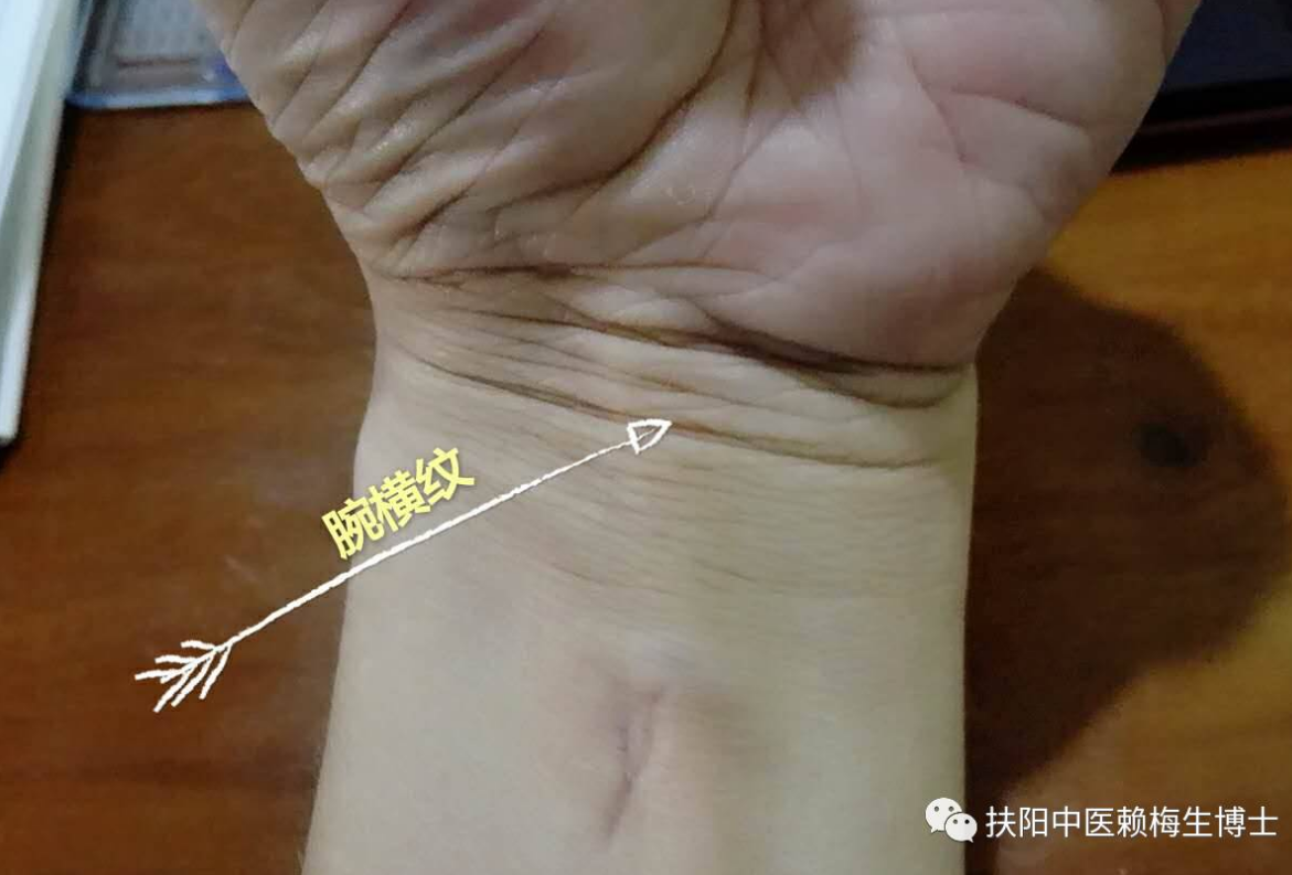正确的腕横纹是桡骨茎突与尺骨茎突连线的那一条