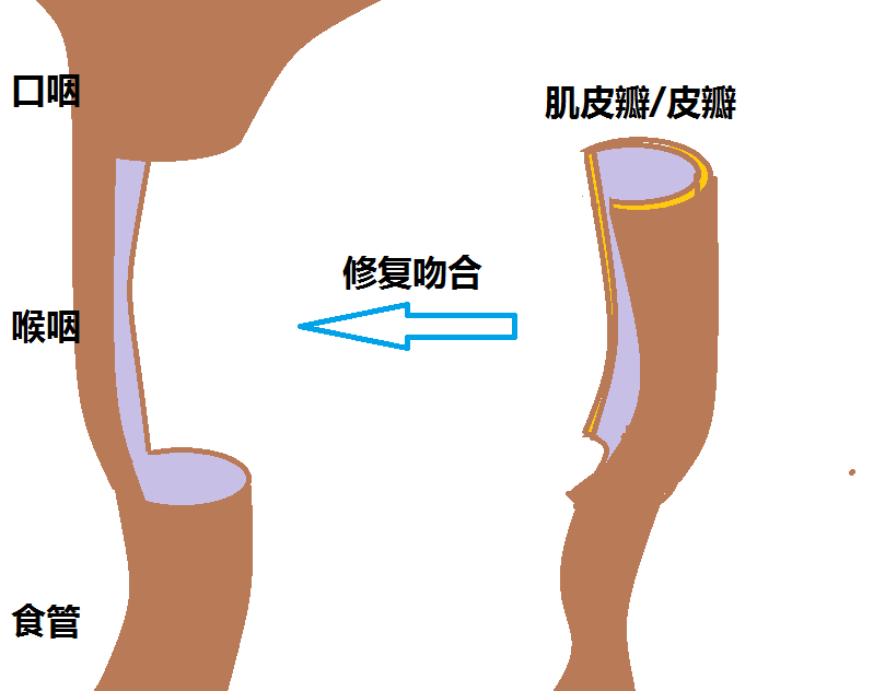 胸大肌皮瓣手术图解图片