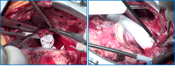 现场直播亚洲首例计算机辅助设计下高难度fontan手术.