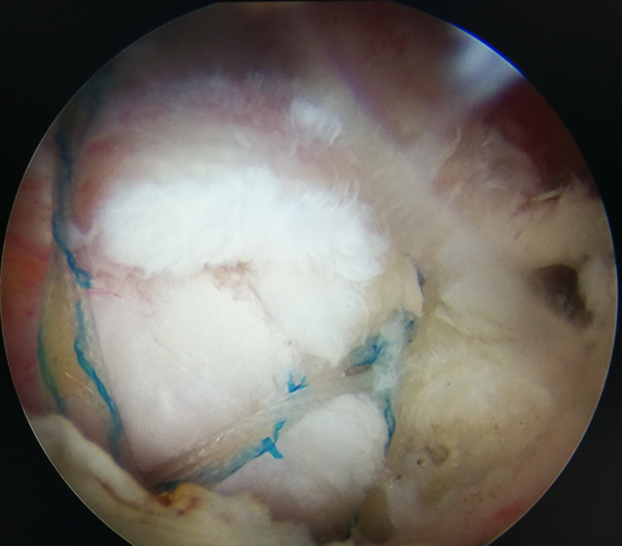 關節鏡下雙排固定,側側縫合治療肩袖反