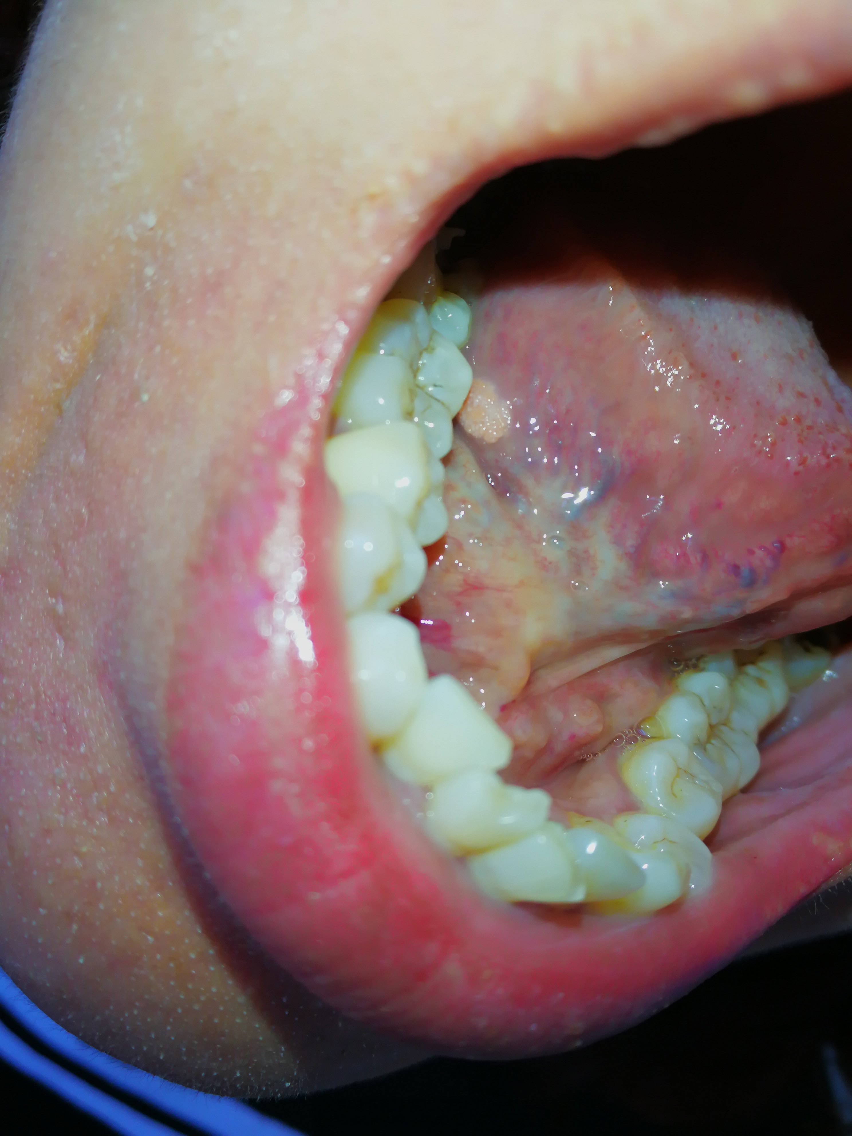 舌头尖锐湿症状图片图片