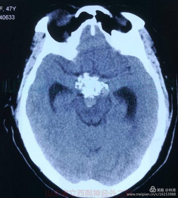 全切巨大钙化颅咽管瘤