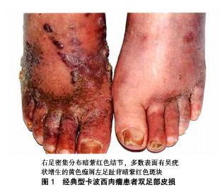 卡波西肉瘤是什么样子的 - 好大夫在线