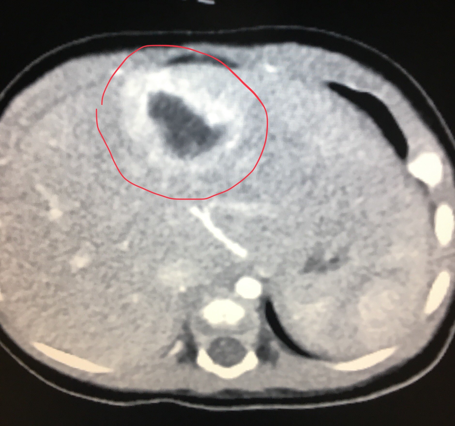 嬰兒型肝血管內皮細胞瘤ct增強檢查:明顯環形強化並逐漸填充瘤體!