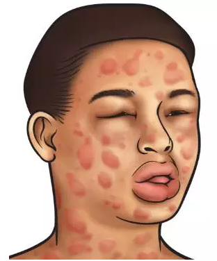 儿童严重过敏反应应怎么处理? - 好大夫在线