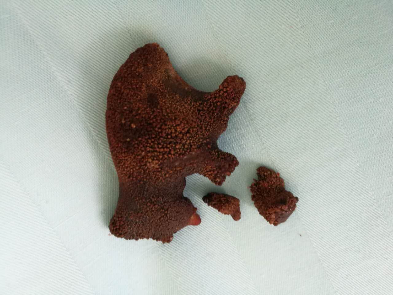 复杂性肾铸形结石腹腔镜最佳的选择