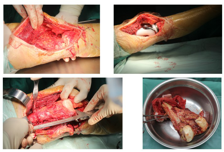 左股骨远端骨肉瘤图片