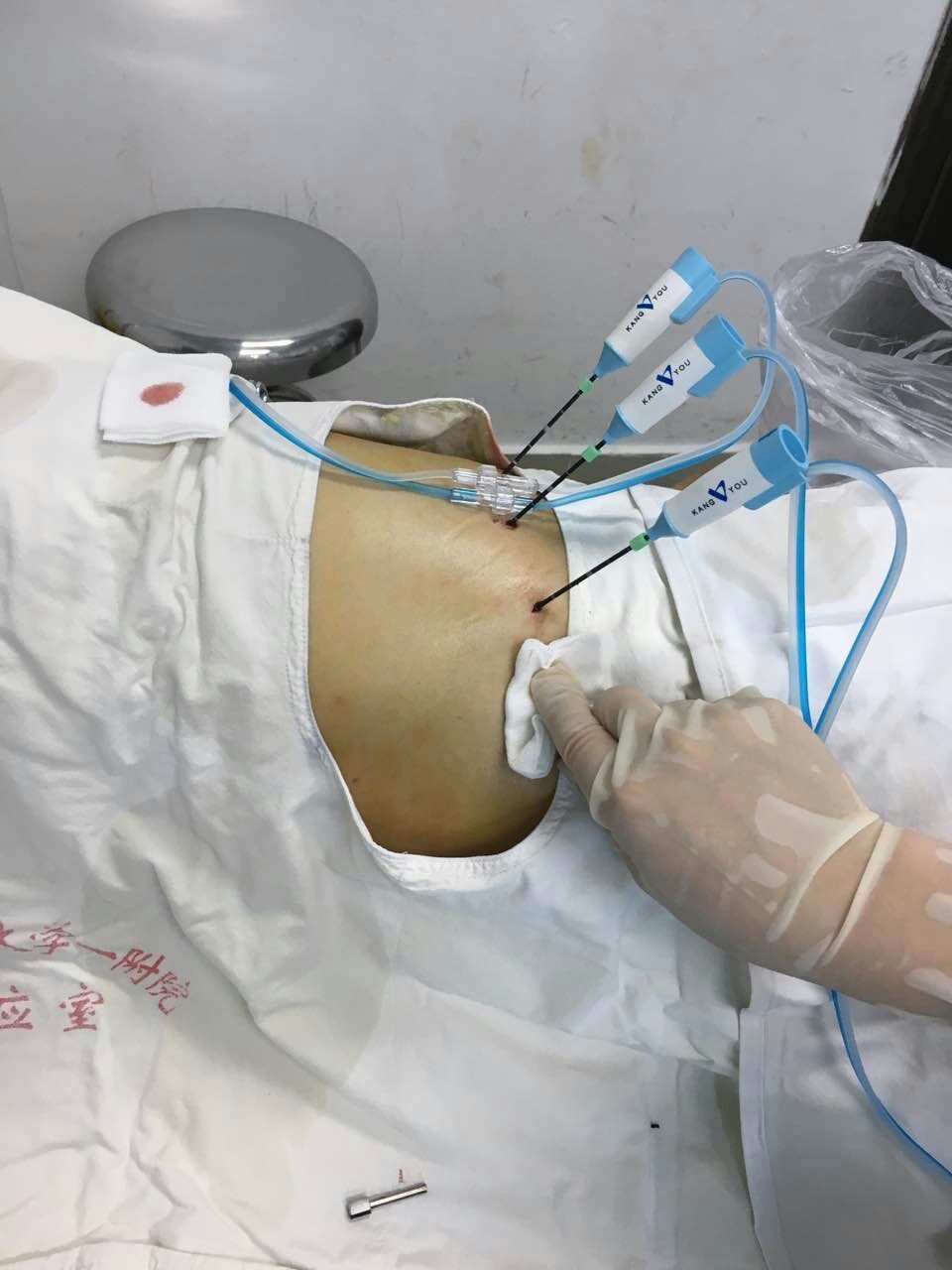 普外科医生日记2:刺向肝癌的利刃----微波消融