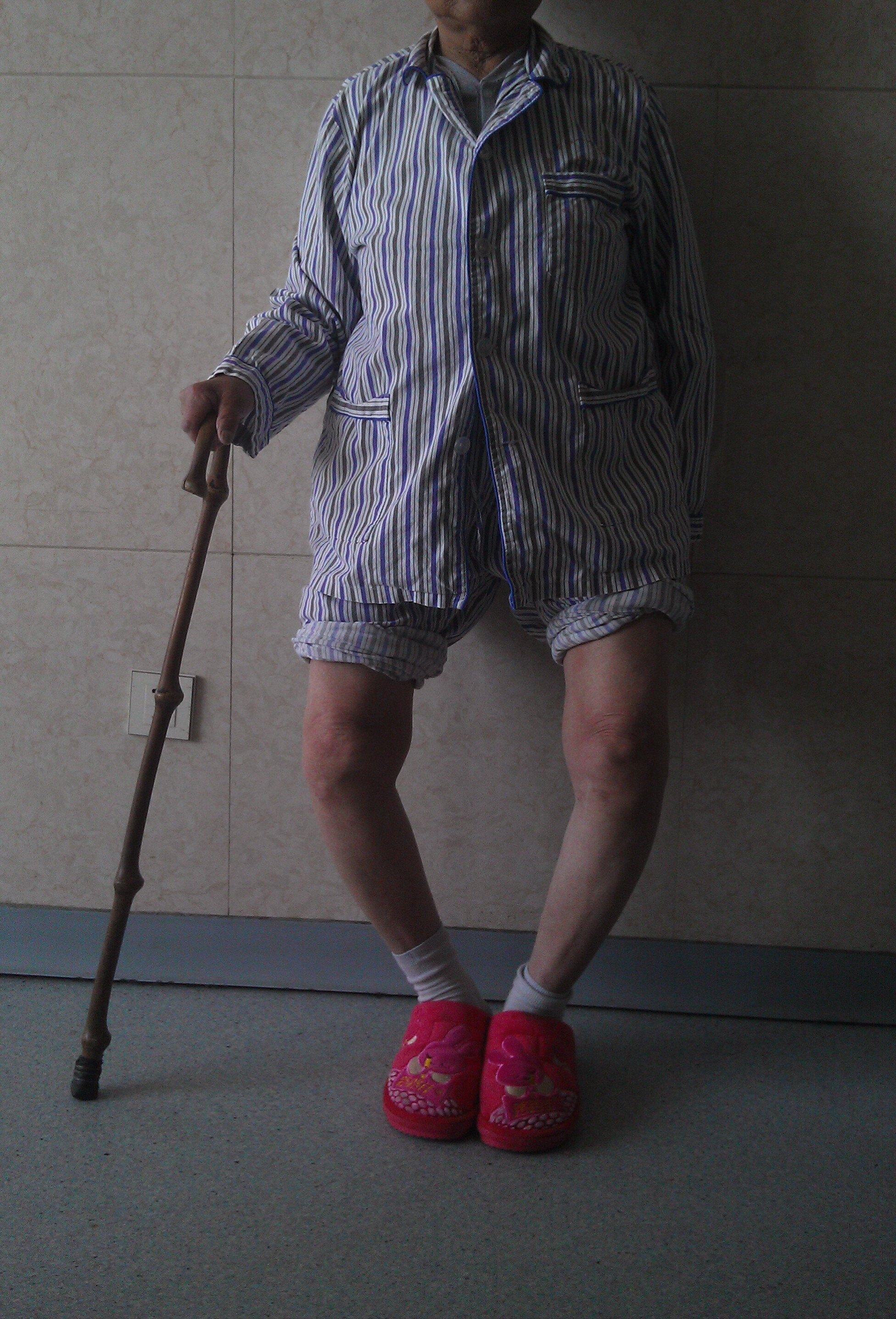 女性 74岁  重度双膝骨性关节病 膝内翻  心脏支架术后术前术前术后