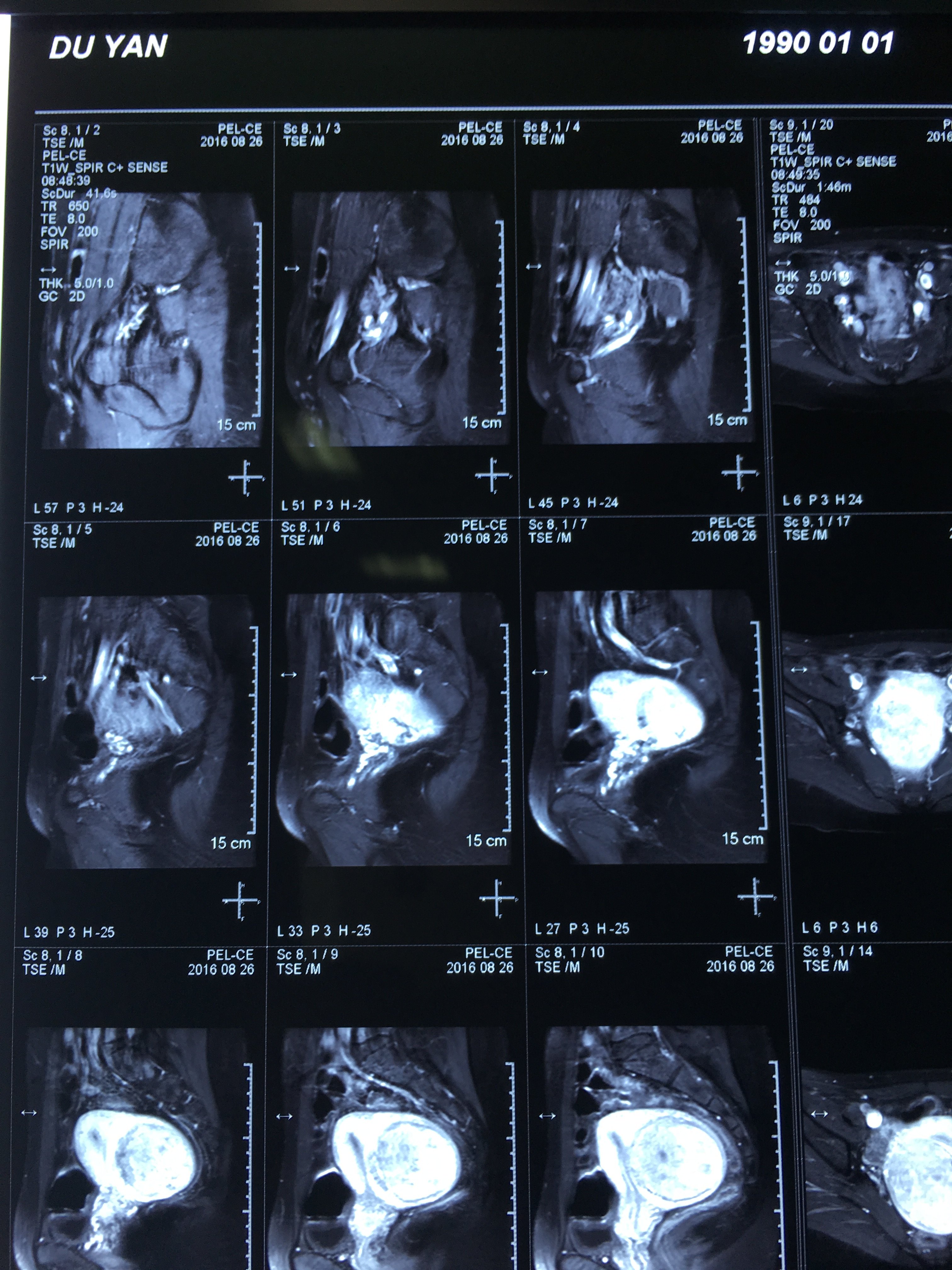 海扶刀治疗前子宫肌瘤增强核磁显示肌瘤血流丰富
