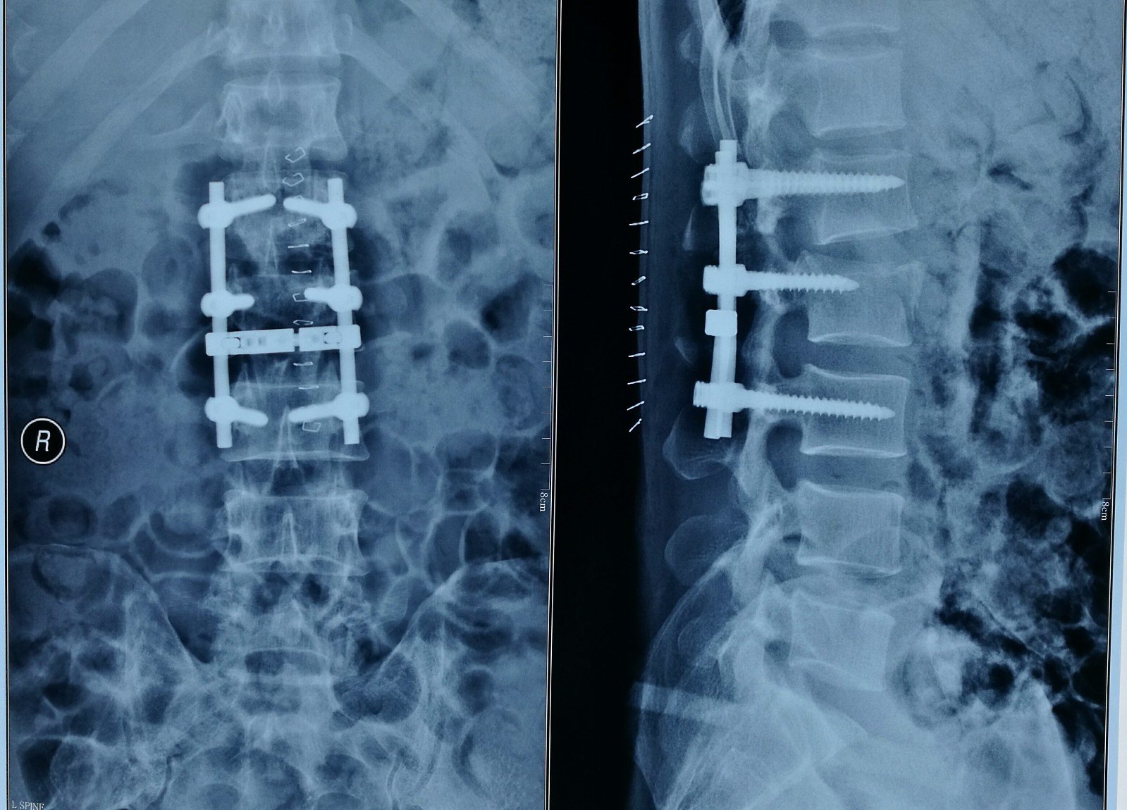 脊髓损伤患者是可以从新站起来的 