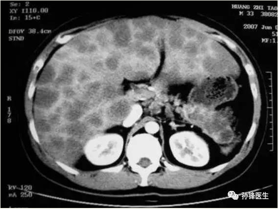 医学小品|肝脏多发囊肿和肝脏转移瘤怎样鉴别?