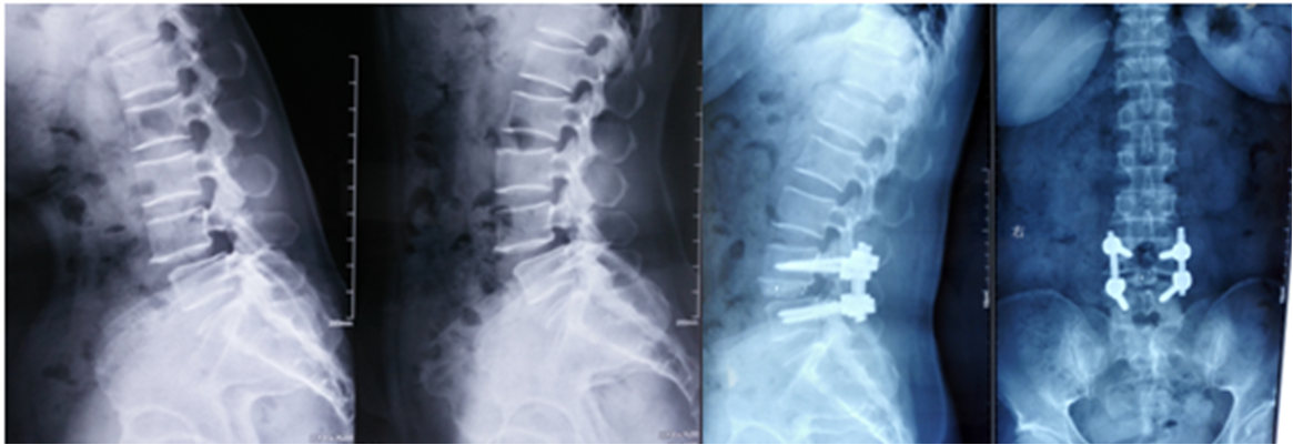 腰椎斜位片图片