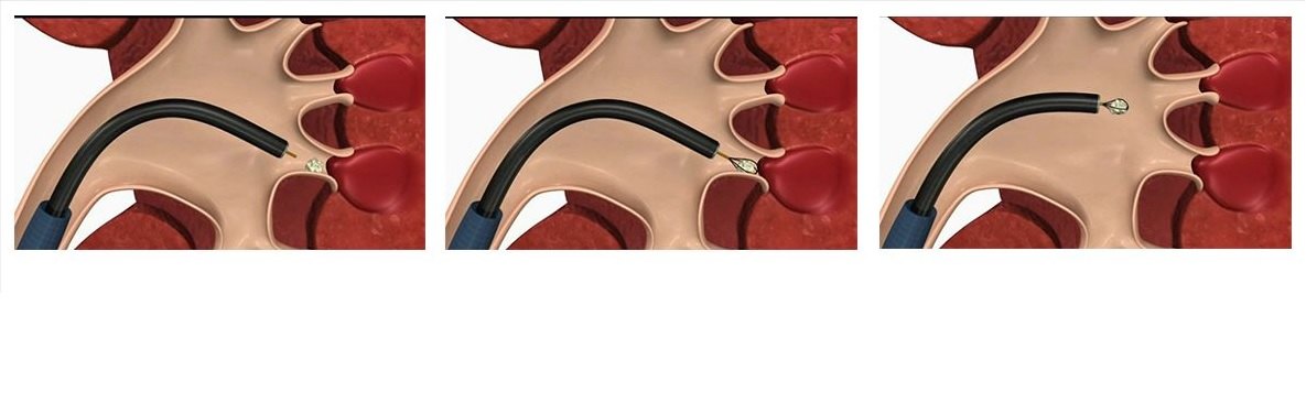 带您了解输尿管软镜碎石手术
