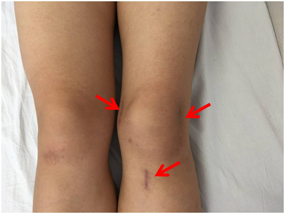 下面是一例11岁女孩的片子,右膝发生习惯性髌骨脱位10个月左右进行
