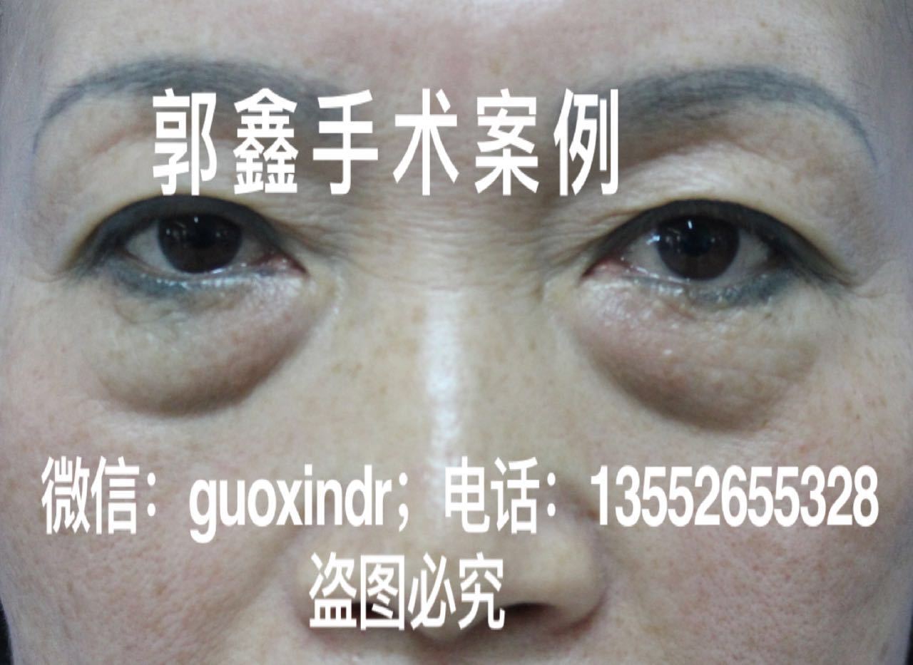 北京去眼袋体验（附详细恢复图） - 知乎