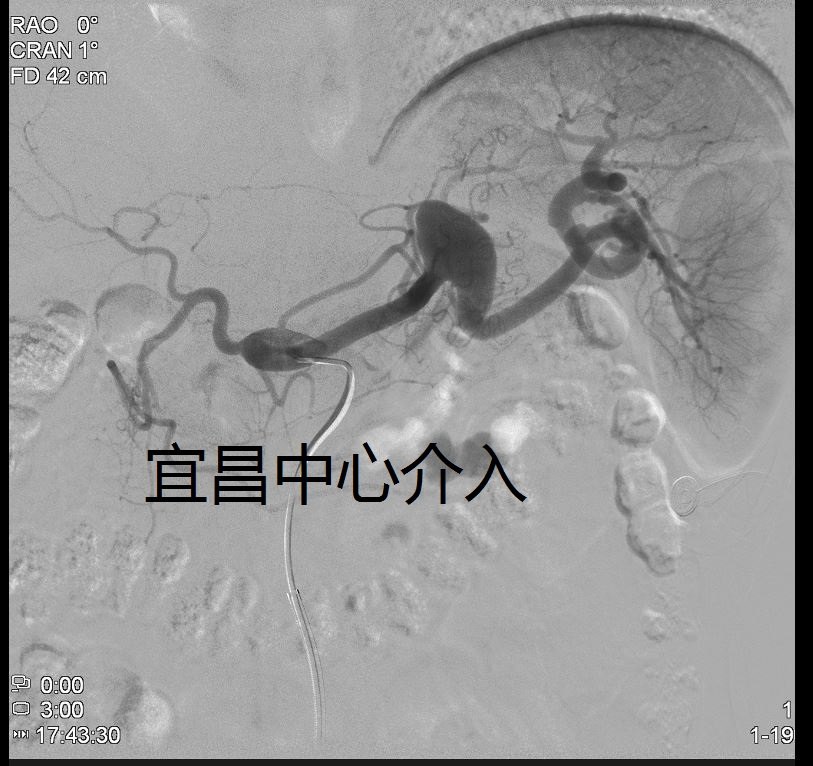 内脏（肝、脾、肾等）动脉瘤的微创介入治疗 - 好大夫在线