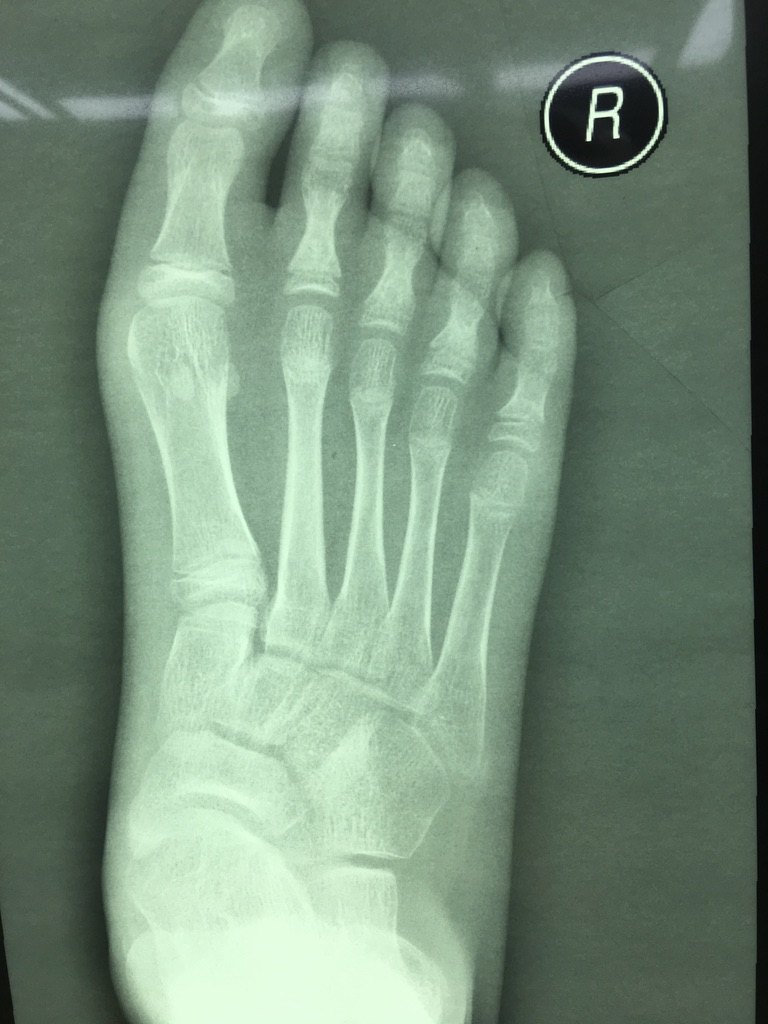 跗骨联合——儿童脚疼的常见原因却被经常漏诊的问题 
