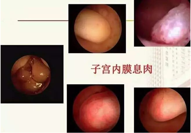 1,诊断检查(如子宫内膜息肉,宫腔粘连等);宫腔镜