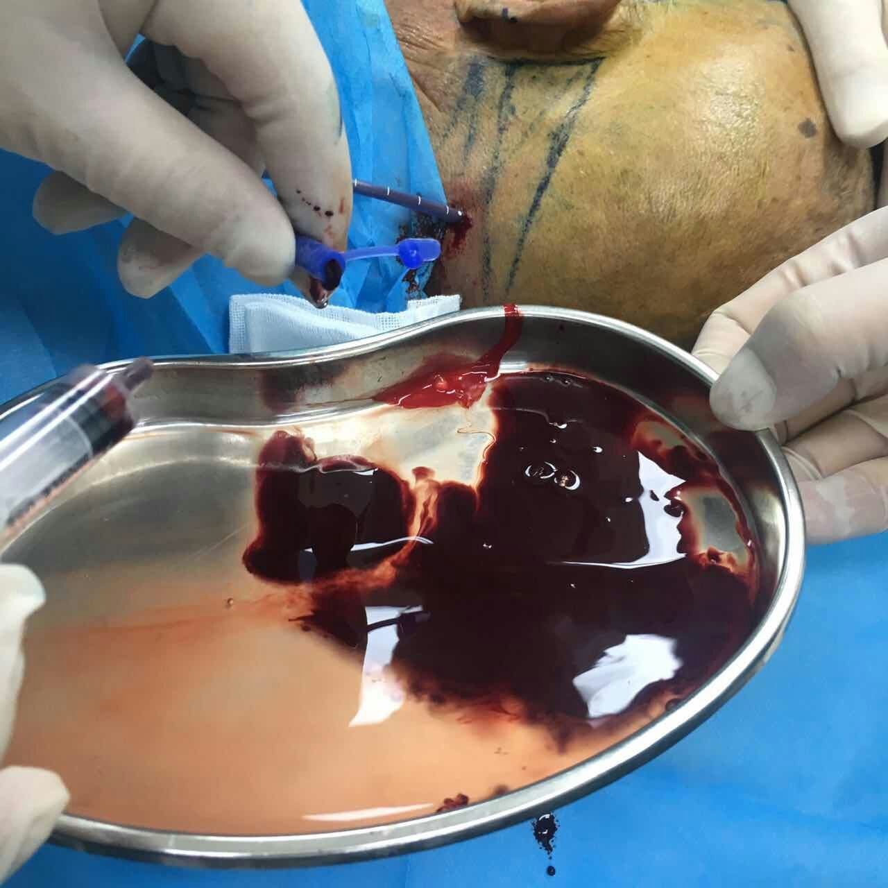 应用微创软通道治疗高血压脑出血效果显著!