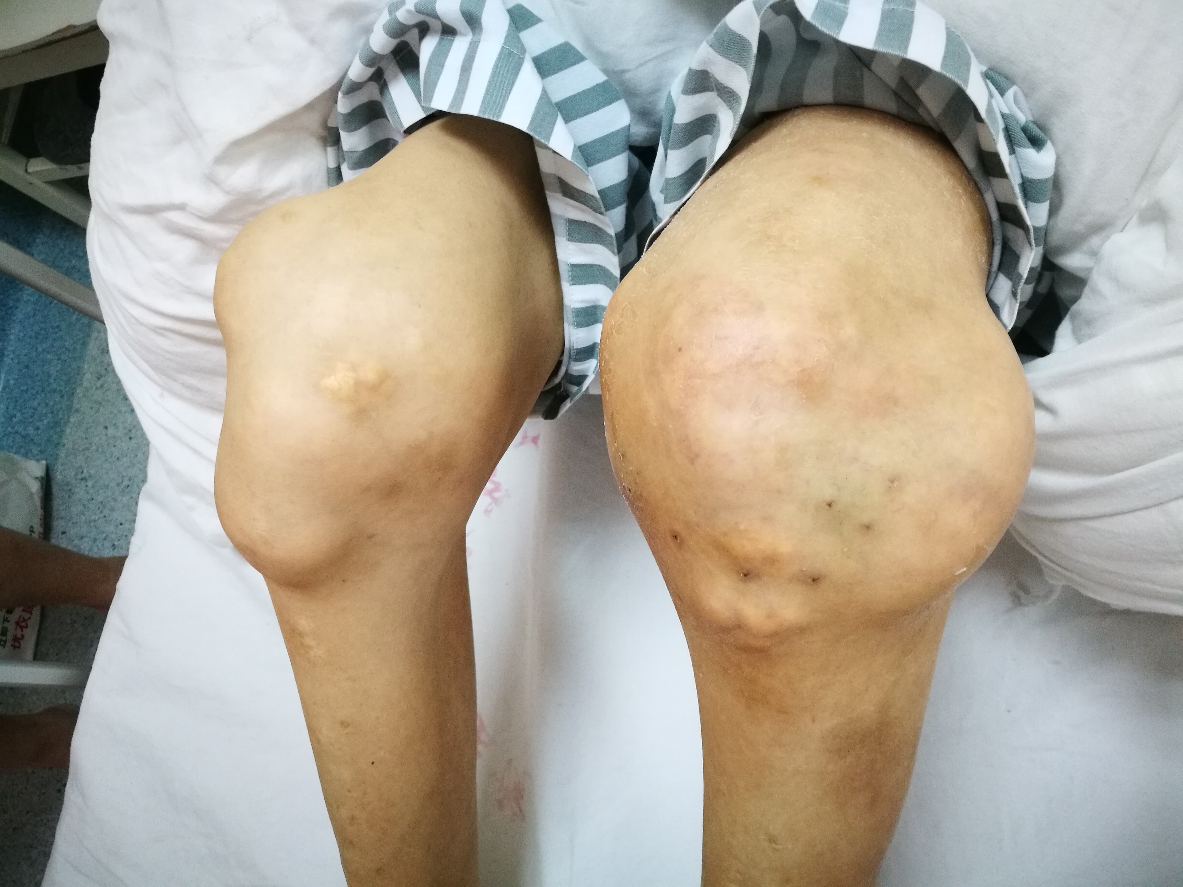 谨记痛风需正规治疗 - 好大夫在线