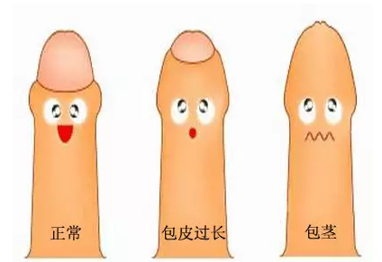 包皮包茎是否需要手术,何时做比较合适?