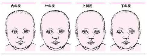 斜视的类型:小儿斜视常能引起弱视,这种斜视性弱视若未经及时,恰当的