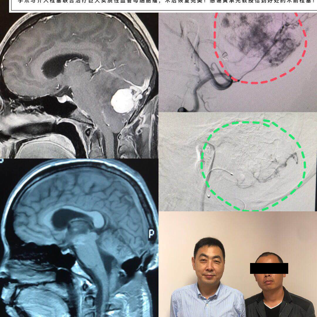 haodf:8:xueguanwangzhuangxibaoliu-->血管母细胞瘤 !
