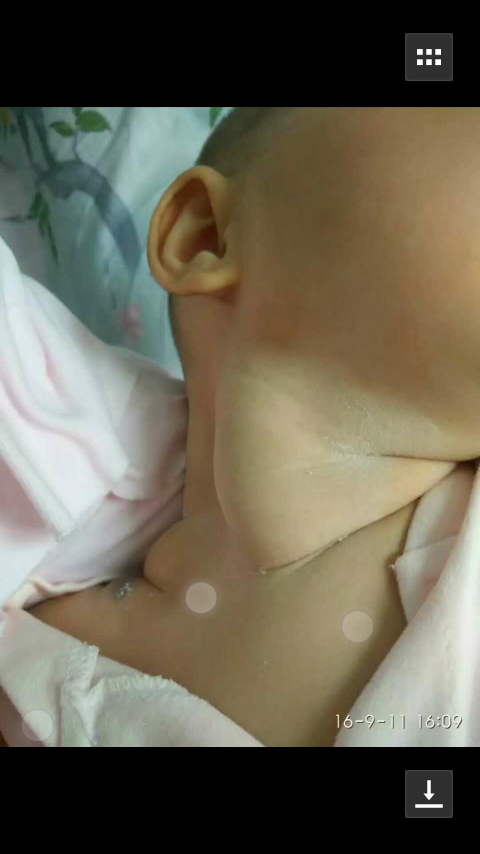 先天性斜颈婴儿图片