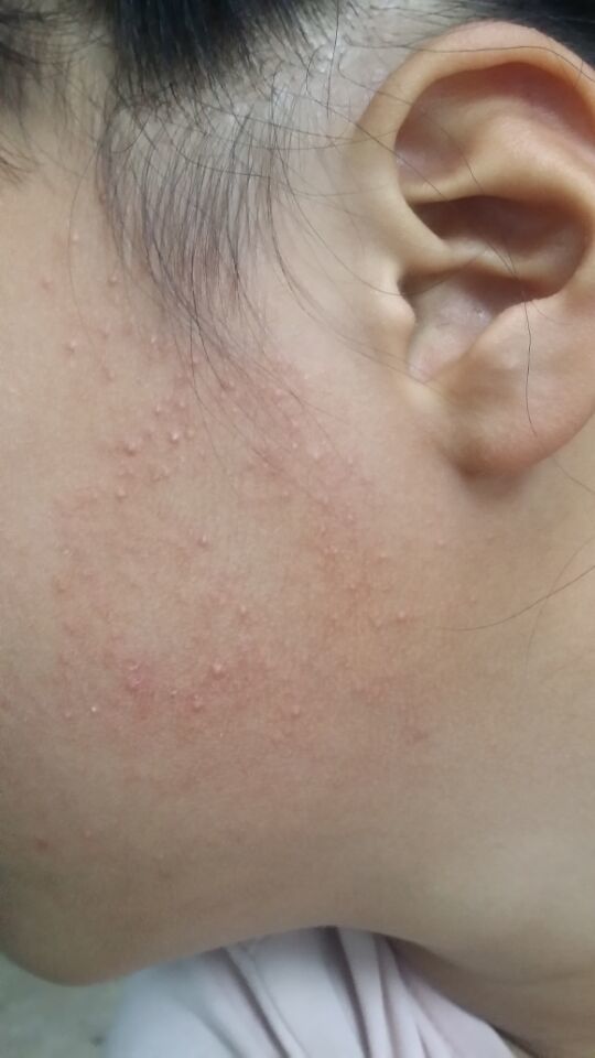 脸上长鸡皮肤是什么样子(脸上长鸡皮肤是什么样子的) 脸上长鸡皮肤是什么样子(脸上长鸡皮肤是什么样子的)