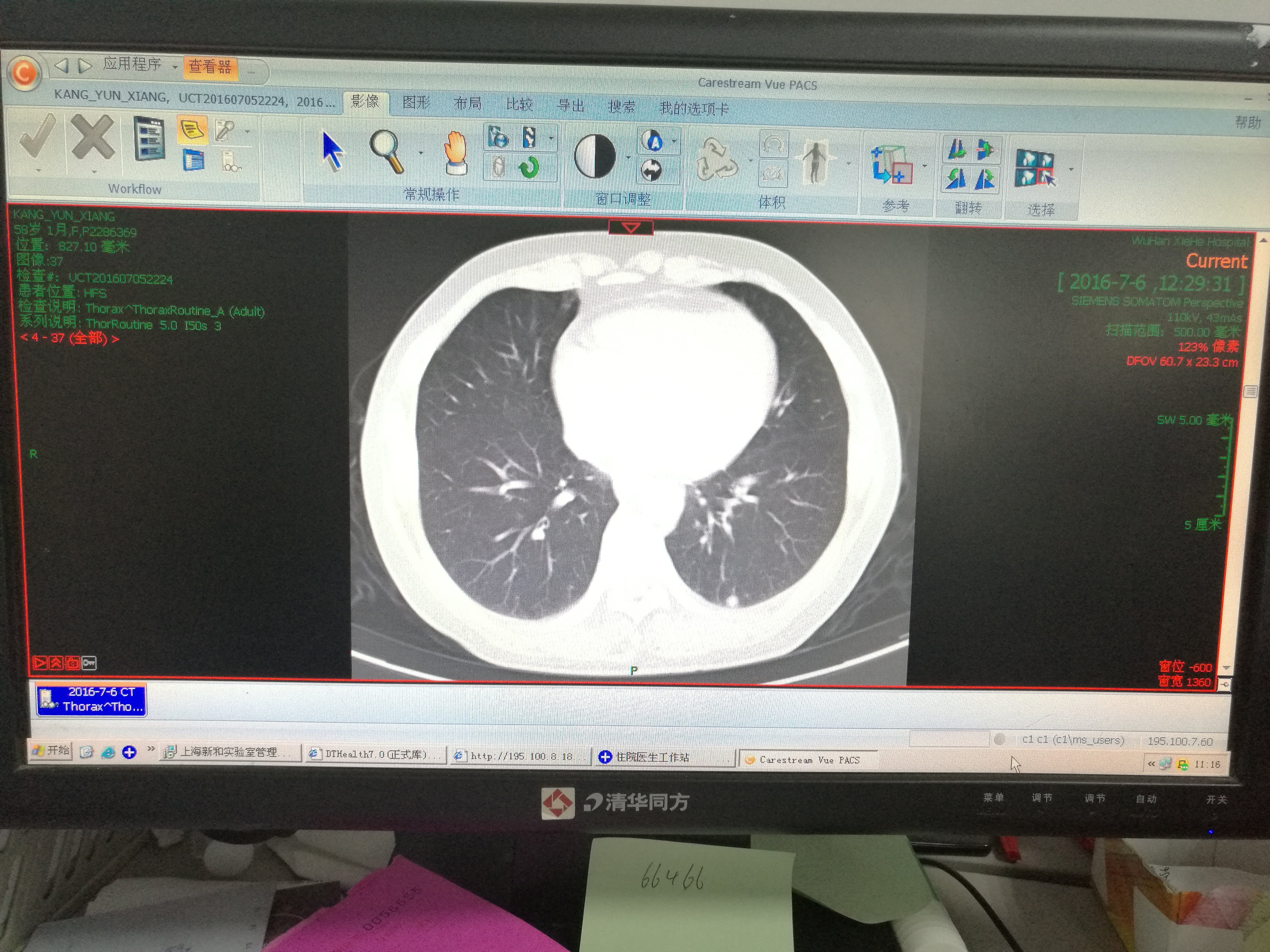 pd1治療轉移性黑色素瘤效果好