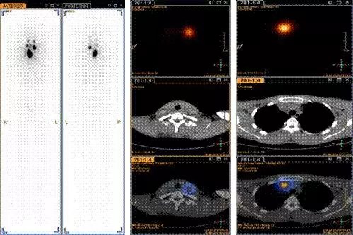 第一次碘治疗后碘-131平面显像和断层融合显像