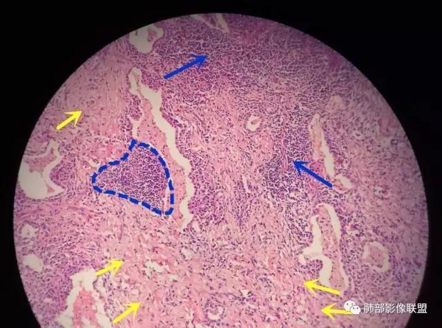 病理3期 第7讲-肺部肉芽肿性炎,普通慢性炎,脓肿病理 - 好大夫在线