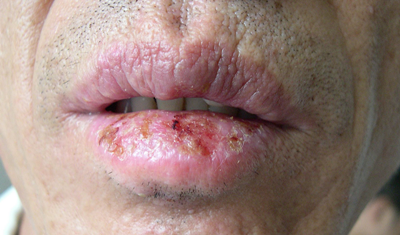 嘴唇究竟做错了什么?-唇炎全攻略