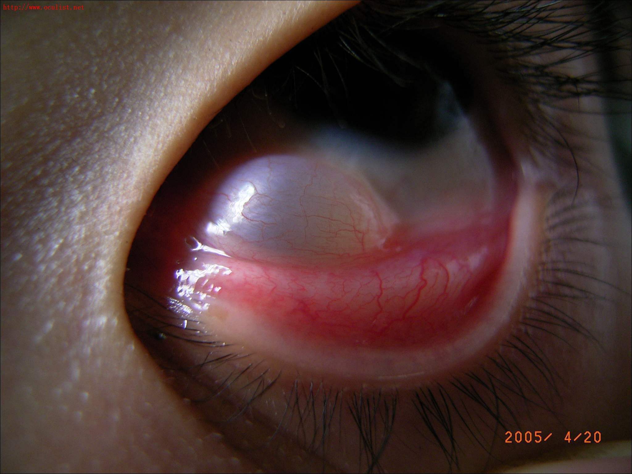 泪腺炎性假瘤图片图片
