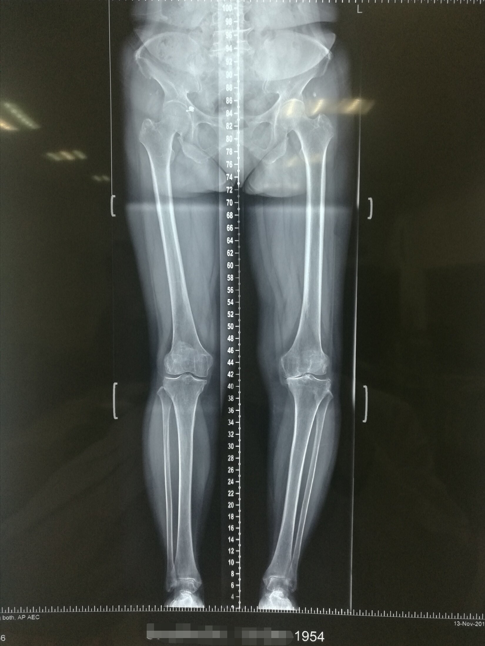 63岁女性,膝关节骨性关节炎,胫骨近端高位截骨术. - 好大夫在线