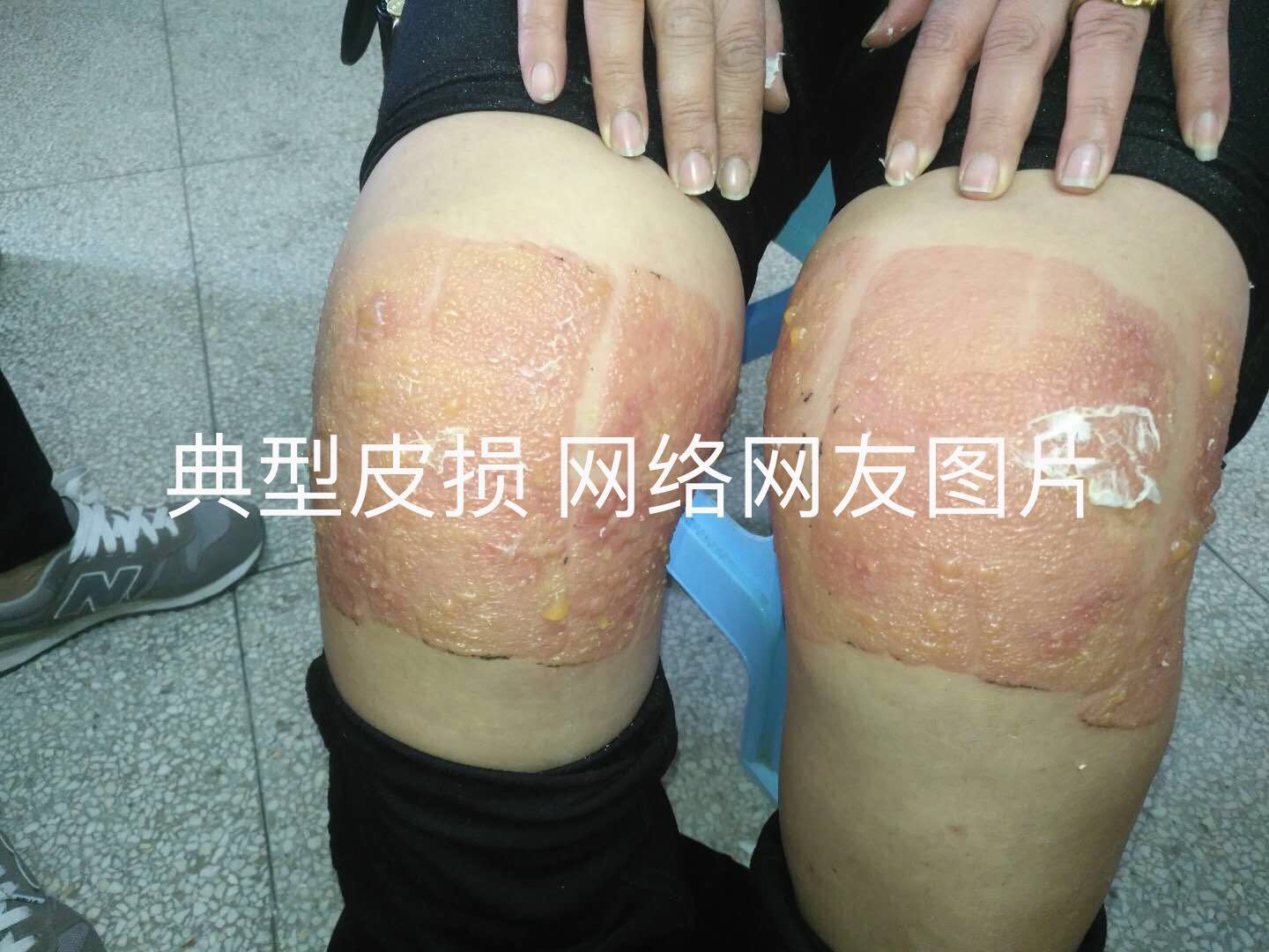 接触性皮炎膏药