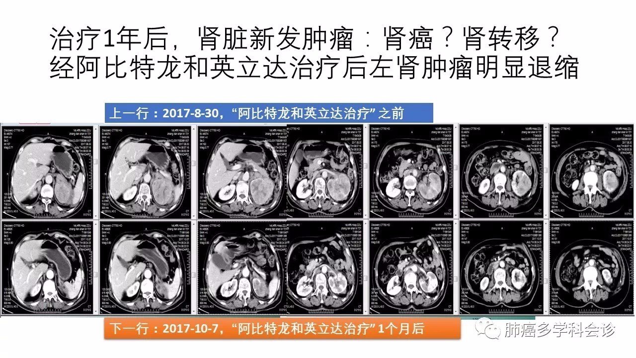 晚期非小细胞肺癌多学科会诊病例分享(2) - 好大夫在线
