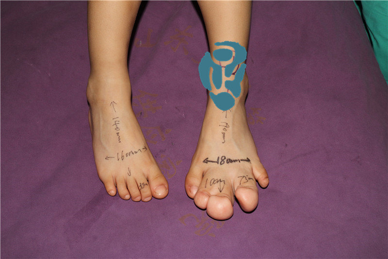 宝宝脚趾头巨大怎么办?