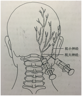 頭痛可能是枕神經惹的禍