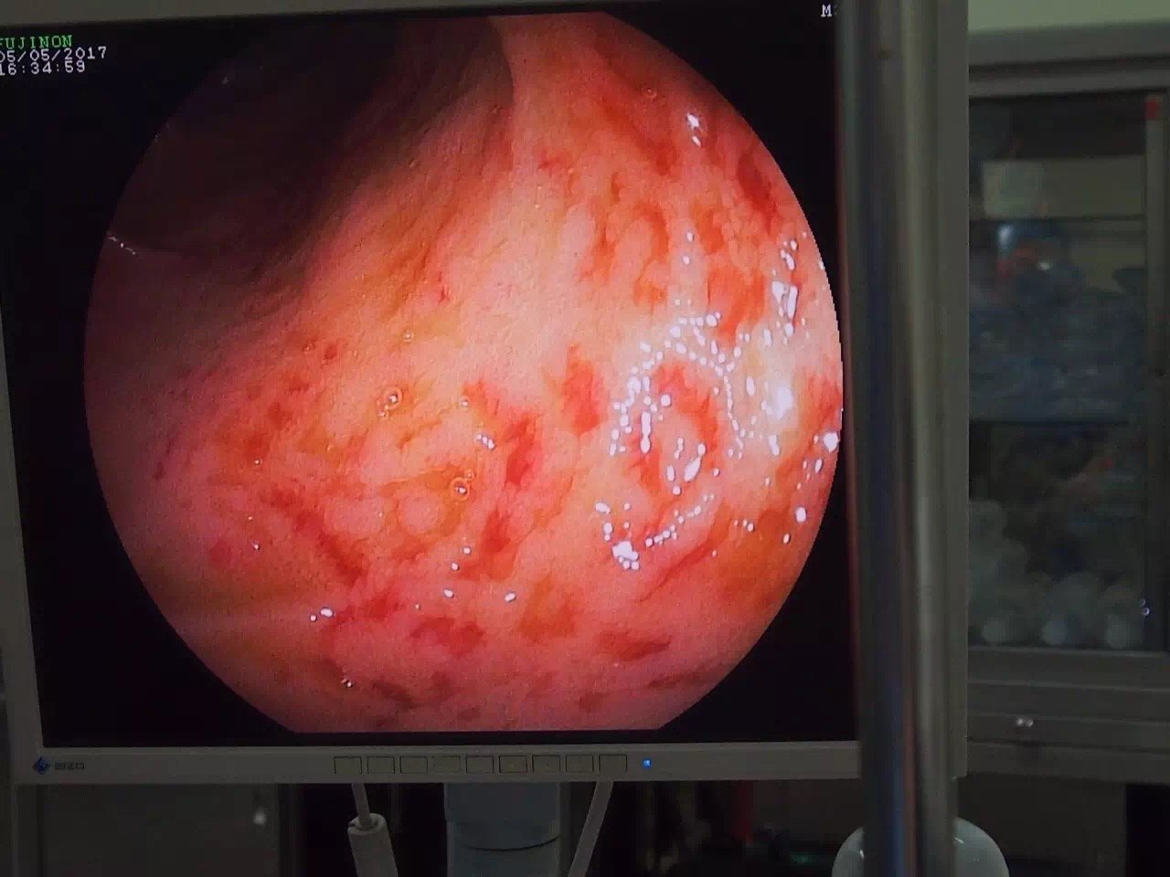 小肠出血sbb原创