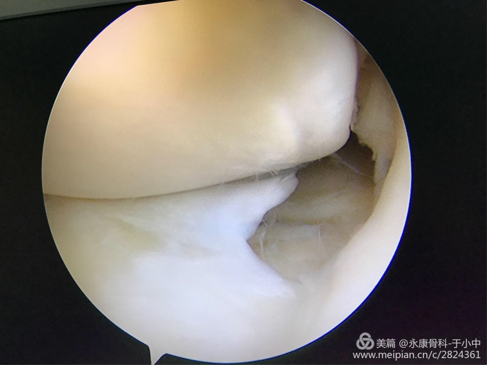 半月板撕裂怎樣進行進行關節鏡手術呢?