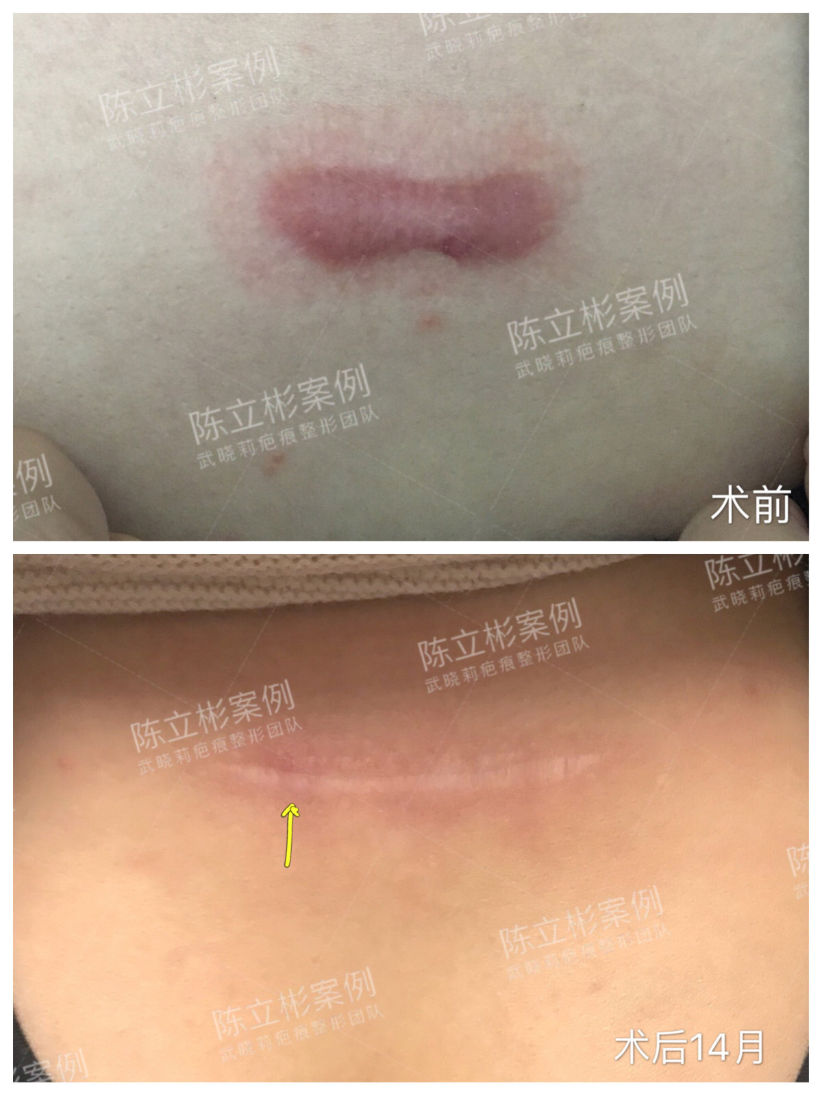 胸部疤痕疙瘩术后14月复诊