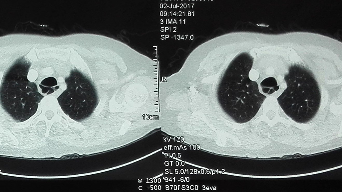 巨大支气管,支气管憩室症 - 好大夫在线