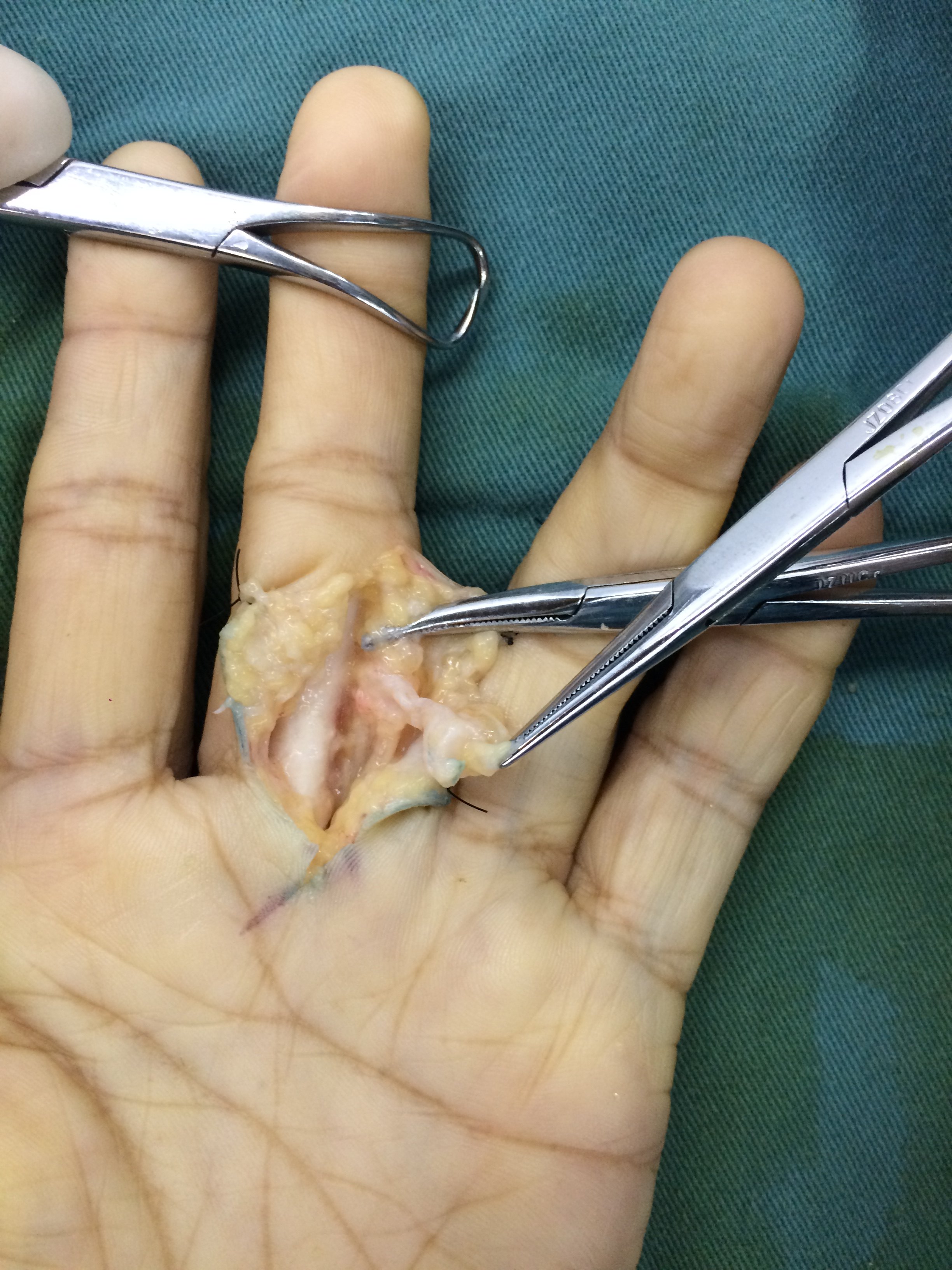 拇指腱鞘切开术图片图片