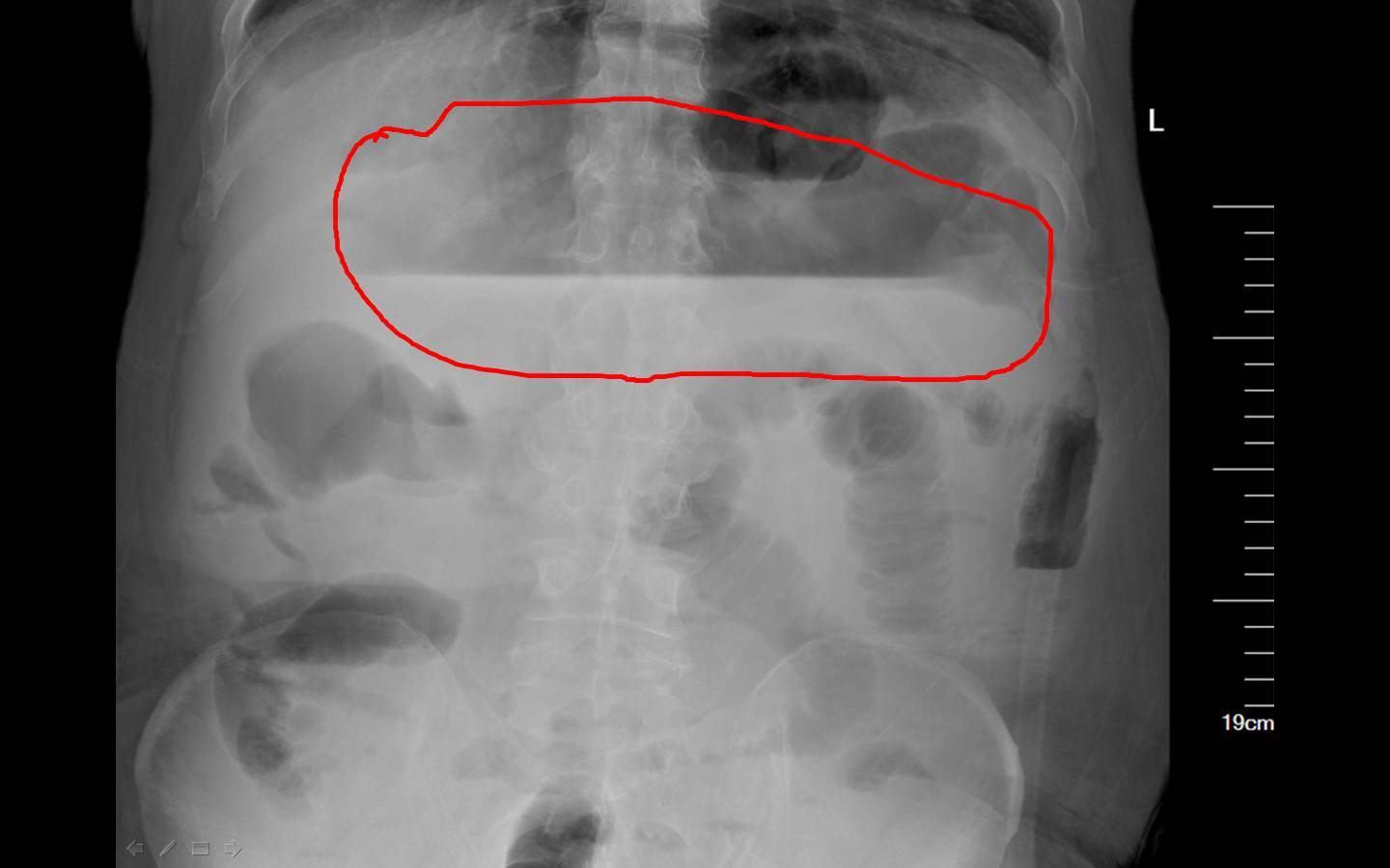 膜假黏液瘤病例(15)--阑尾囊肿到底能长多大?