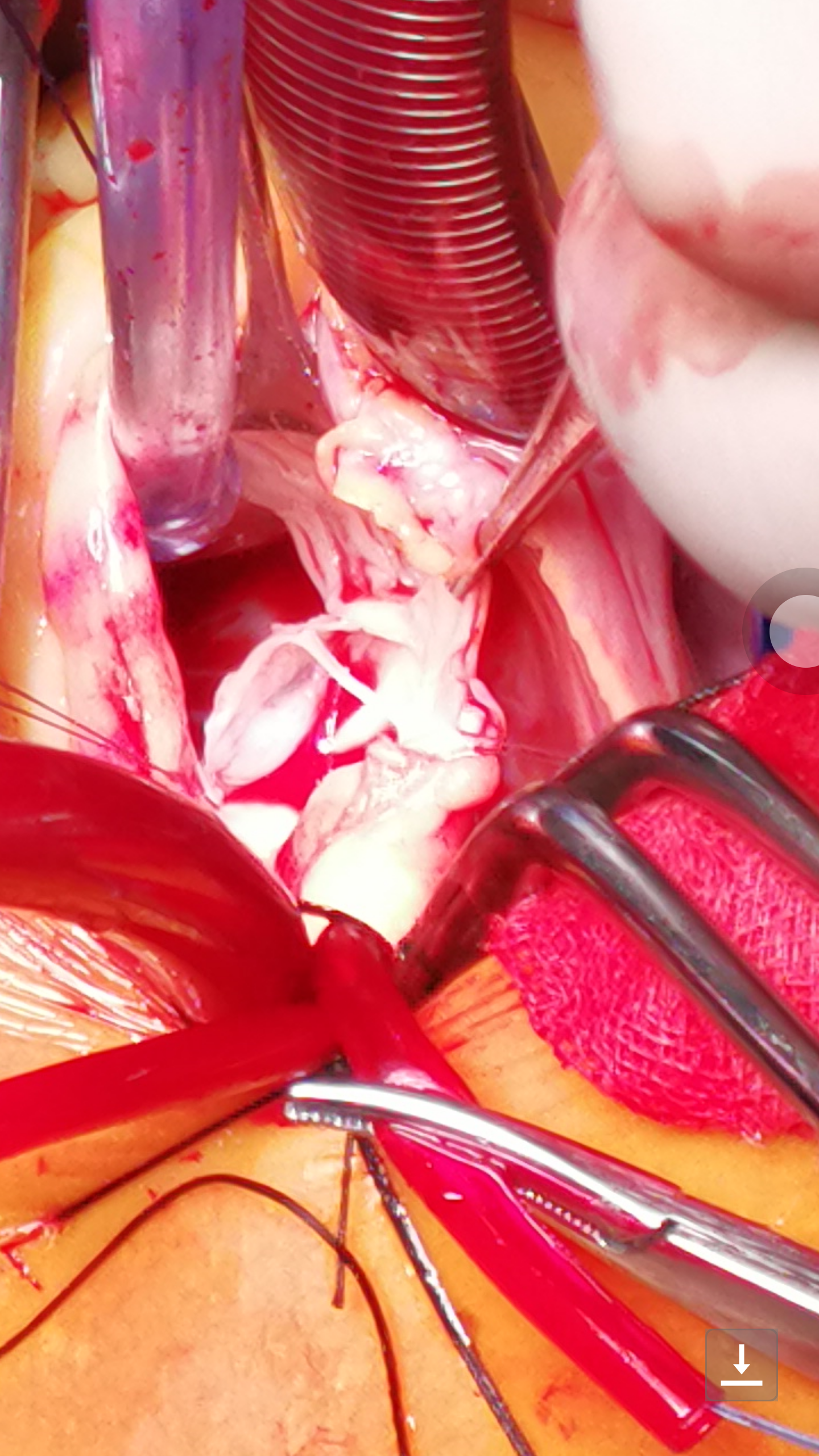 血压高导致主动脉瓣撕裂